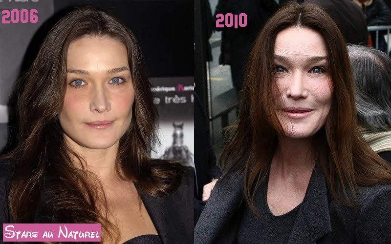 carla bruni chirurgie